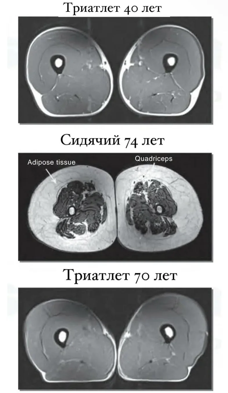 Сравнение МРТ мышц бёдер у триатлетов и малоподвижного человека